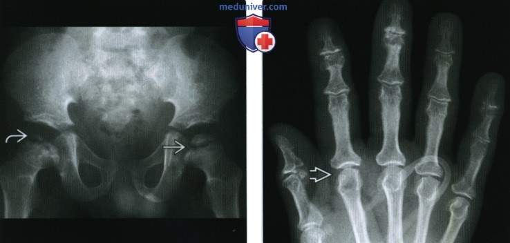 Болезни костей при нарушениях обмена - лучевая оценка