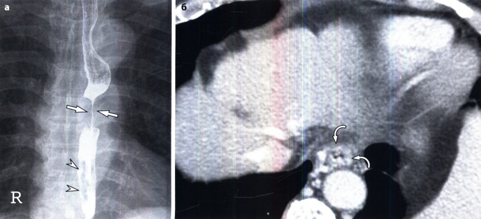 Рентгенограмма при варикозном расширении вен пищевода