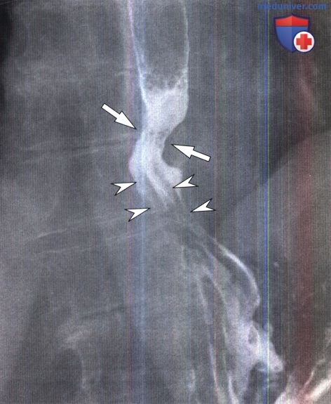 Рентгенограмма при грыже пищеводного отверстия диафрагмы (ГПОД)