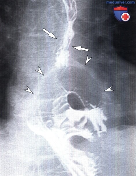 Рентгенограмма при грыже пищеводного отверстия диафрагмы (ГПОД)