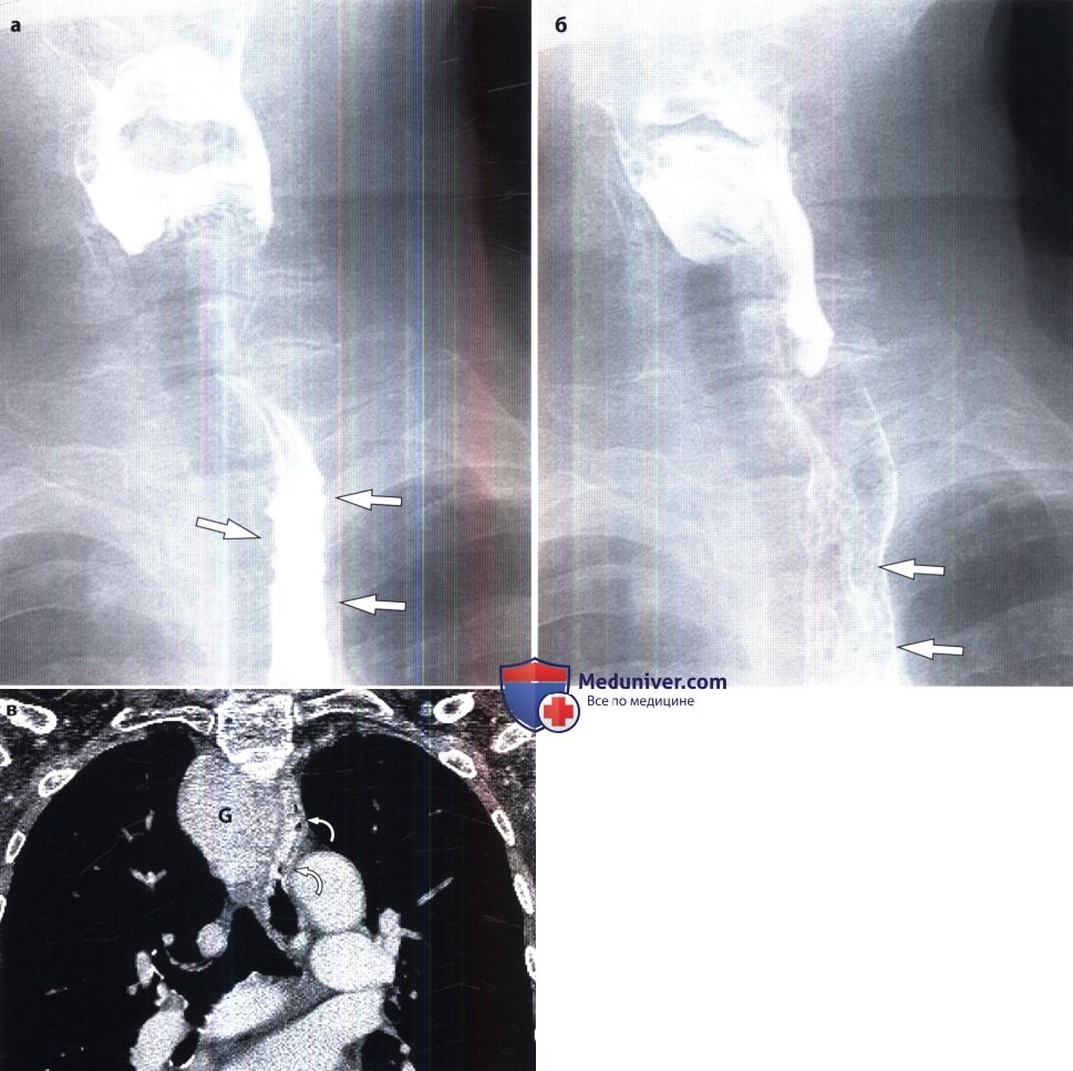 Рентгенограмма при варикозном расширении вен пищевода