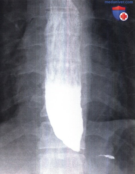 Рентгенограмма при ахалазии пищевода