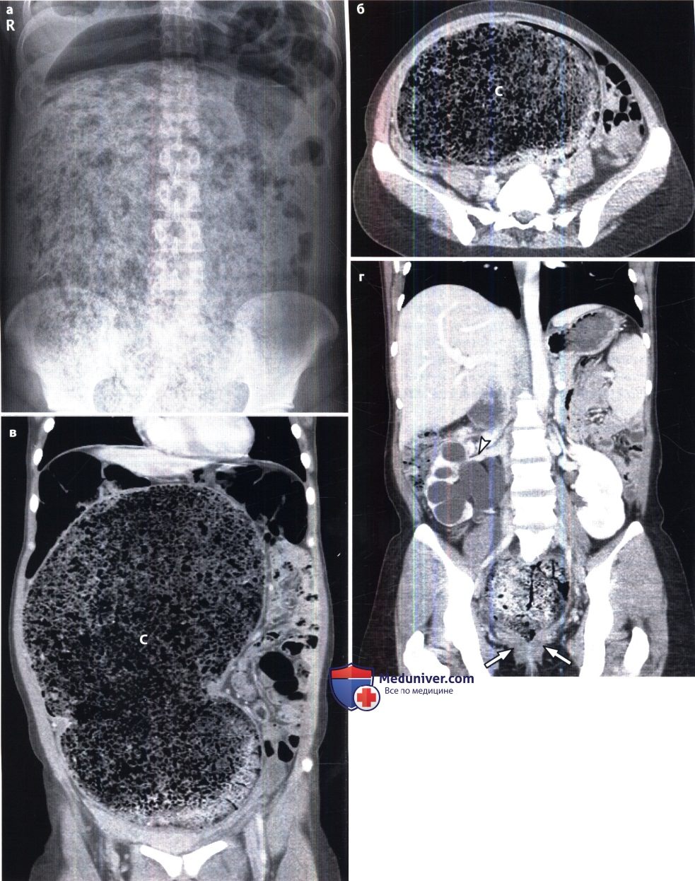 Болезнь гиршпрунга прямой кишки на рентгенограмме thumbnail