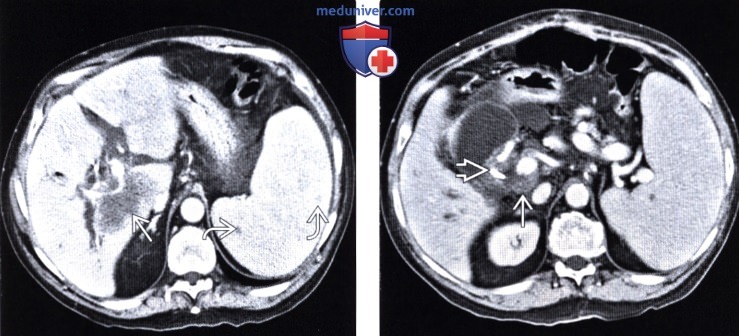 КТ брюшной полости при посттрансплантационном лимфопролиферативном заболевании