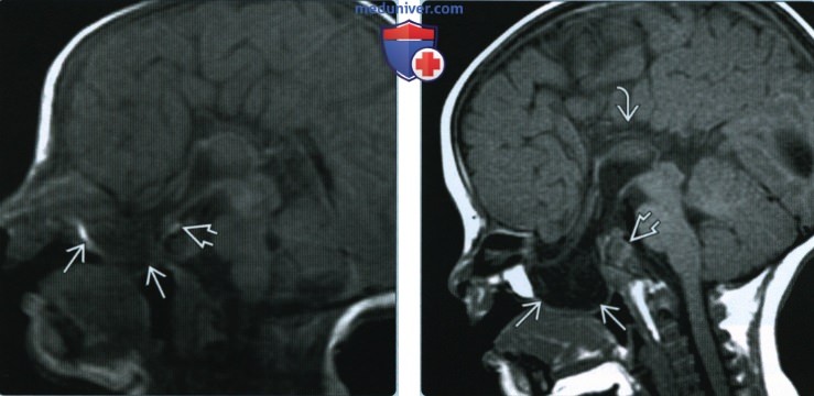 Цефалоцеле основания черепа - лучевая диагностика