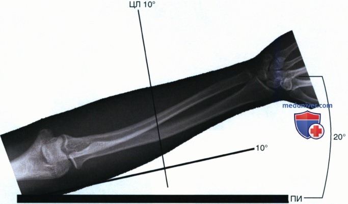 Рекомендации по взаимному расположению центрального луча (ЦЛ), изучаемой части тела и приемника изображения (ПИ) при цифровой (компьютерной) рентгенографии