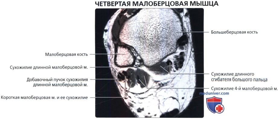 Четвертая малоберцовая мышца на МРТ