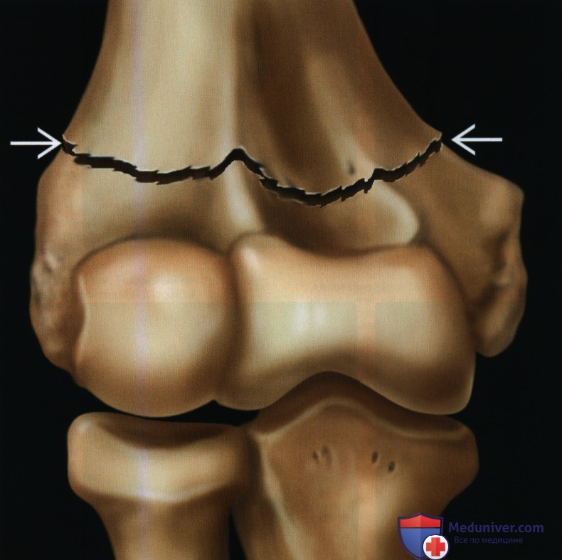 Признаки чрезмыщелкового (надмыщелкового) перелома локтевого сустава