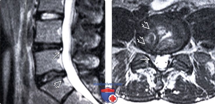 КТ, МРТ при дегенеративном поражении межпозвоночных дисков