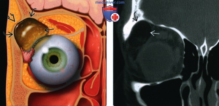 Дермоид и эпидермоид глазницы - лучевая диагностика