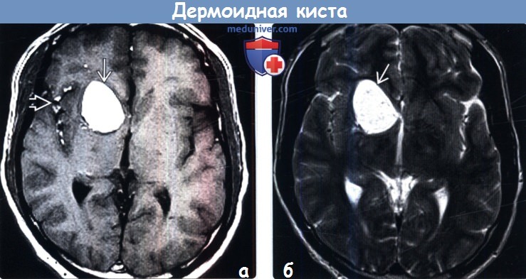 Нейроглиальная киста на МРТ