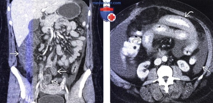 Лучевая диагностика ангиоэдемы (ангионевротического отека) кишечника