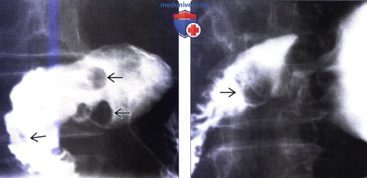 Лучевая диагностика гиперплазии бруннеровых желез