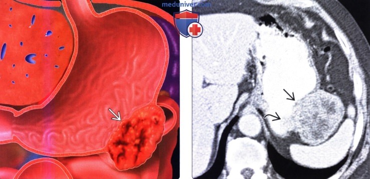 Лучевая диагностика гастроинтестинальной стромальной опухоли (ГИСО) желудка