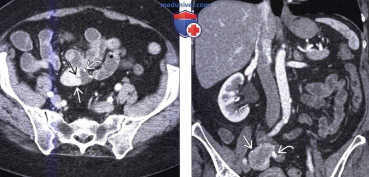 Лучевая диагностика гастроинтестинальной стромальной опухоли (ГИСО) тонкой кишки