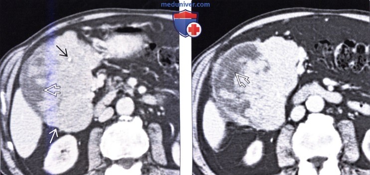 Лучевая диагностика гастроинтестинальной стромальной опухоли (ГИСО) тонкой кишки