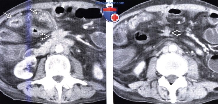 Лучевая диагностика карциноида (карциноидной опухоли) желудочно-кишечного тракта