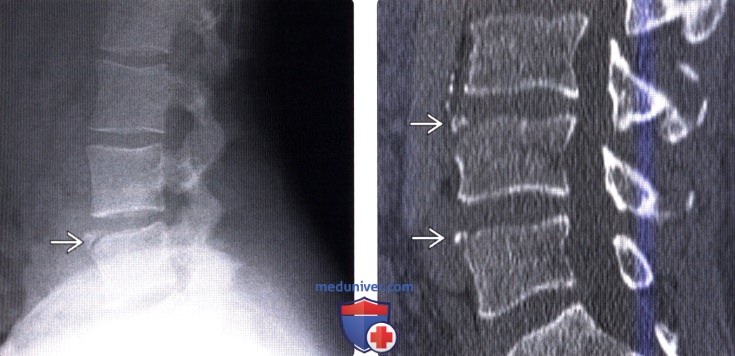 Лучевая диагностика limbus vertebra (LV, краевого апофиза, КА)