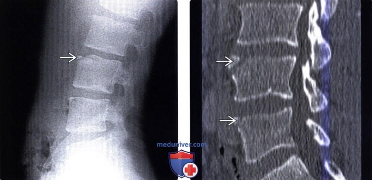   limbus vertebra (LV,  , )