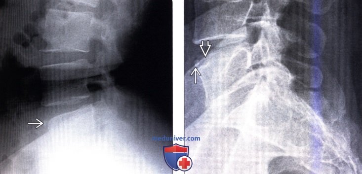 Лучевая диагностика limbus vertebra (LV, краевого апофиза, КА)