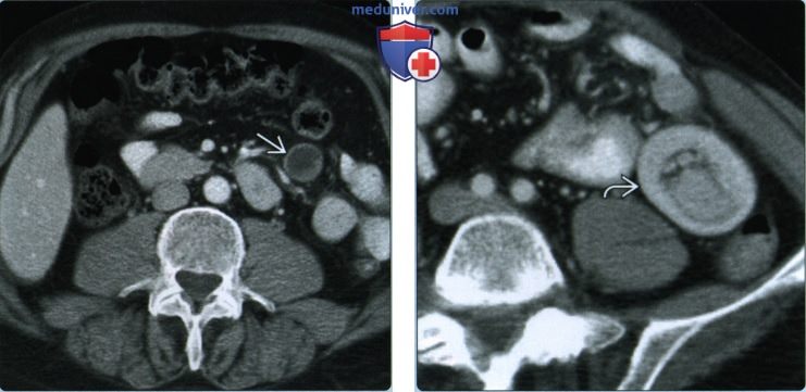 Лучевая диагностика метастаза в стенку тонкой кишки и лимфомы тонкой кишки