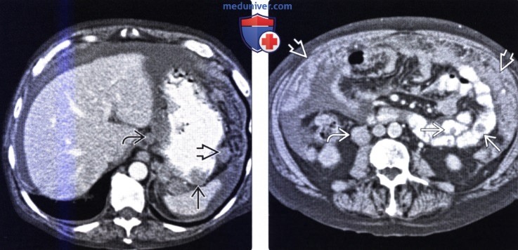 Лучевая диагностика метастаза в желудок и лимфомы желудка