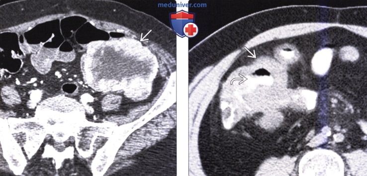 Лучевая диагностика метастаза в стенку толстой кишки и лимфомы толстой кишки