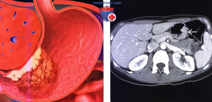 Лучевая диагностика рака желудка