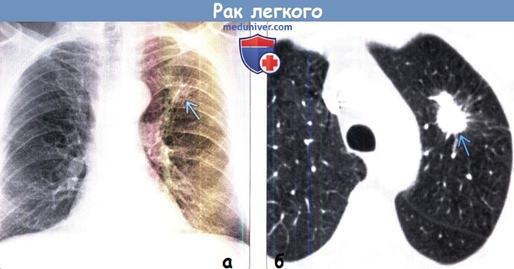 Рак Легких На Рентгене Фото