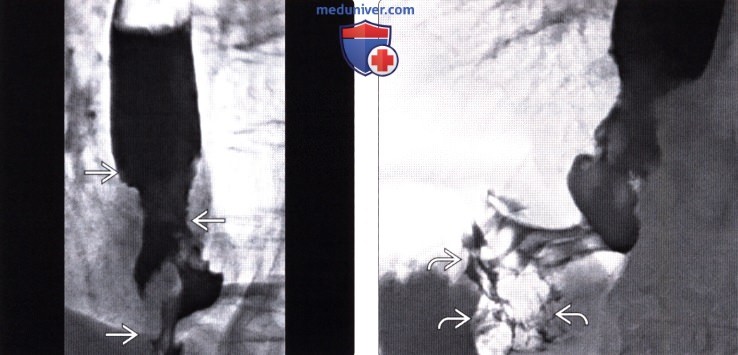 Рентгенография (эзофагография), КТ, МРТ, УЗИ при раке пищевода