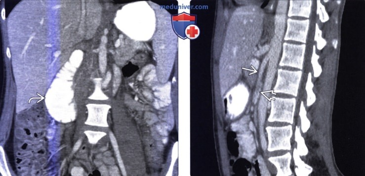 Лучевая диагностика синдрома верхней брыжеечной артерии
