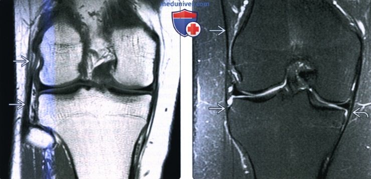 Введение в лучевую диагностику травм коленного сустава
