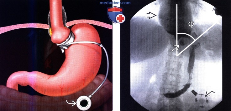 Лучевая диагностика в бариатрической хирургии (после операции с целью снижения веса)