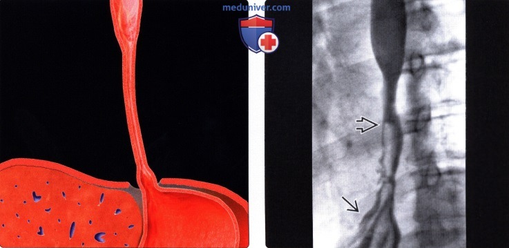 Ожог пищевода рентгенологическая картина thumbnail