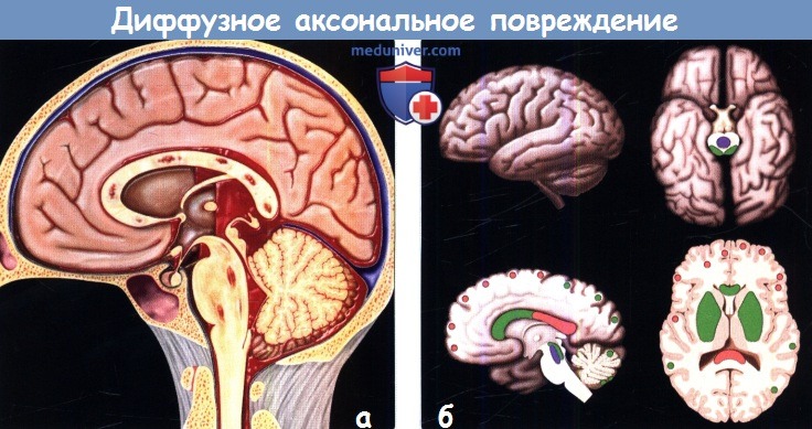 Диффузная травма головного. Диффузное аксональное повреждение мозга. Диффузное аксональное повреждение кт. Аксональное повреждение иллюстрации. Травма головного мозга диффузная s06.2.