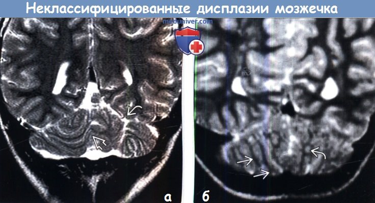Дисплазия мозжечка на МРТ