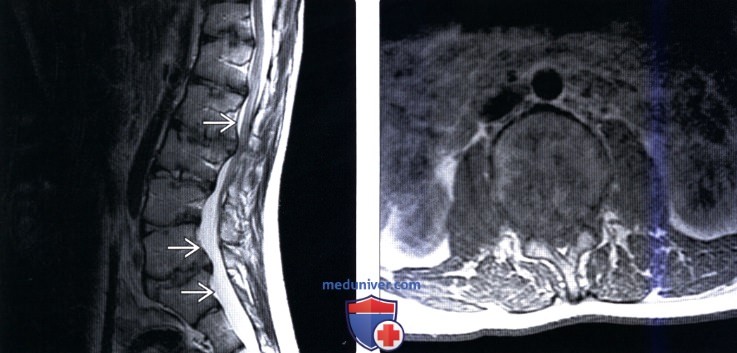 МРТ позвоночника при дисплазии соединительной ткани