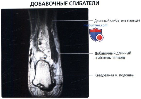 Добавочные мышцы сгибатели пальцев стопы на МРТ