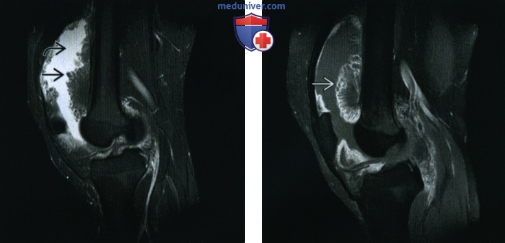 Древовидная липома коленного сустава - лучевая диагностика