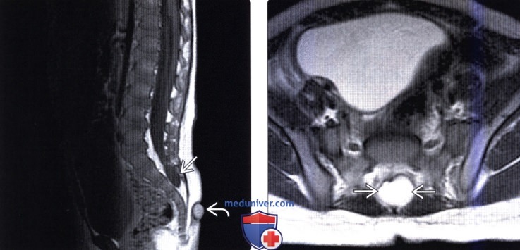МРТ при экстрадуральной арахноидальной кисте крестца
