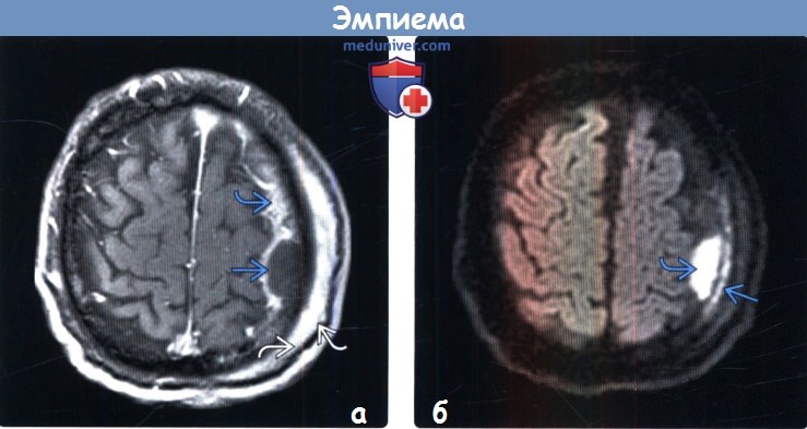 Эмпиема головного мозга на МРТ