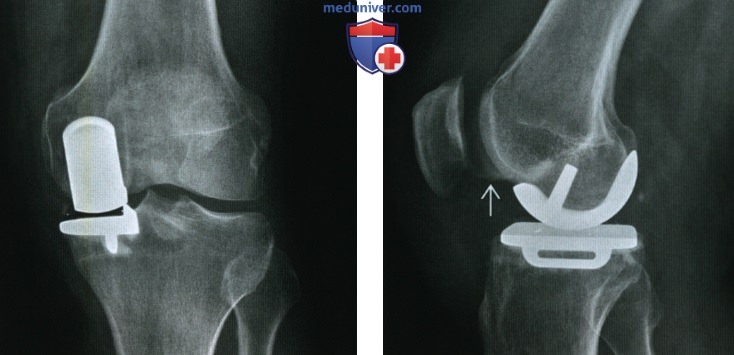 Эндопротез коленного сустава - лучевая оценка