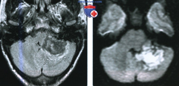 Эпидермоидная киста мостомозжечкового угла (ММУ) и внутреннего слухового канала (ВСК) - лучевая диагностика