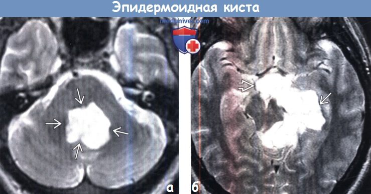 Эпидермоидная киста головного мозга на МРТ