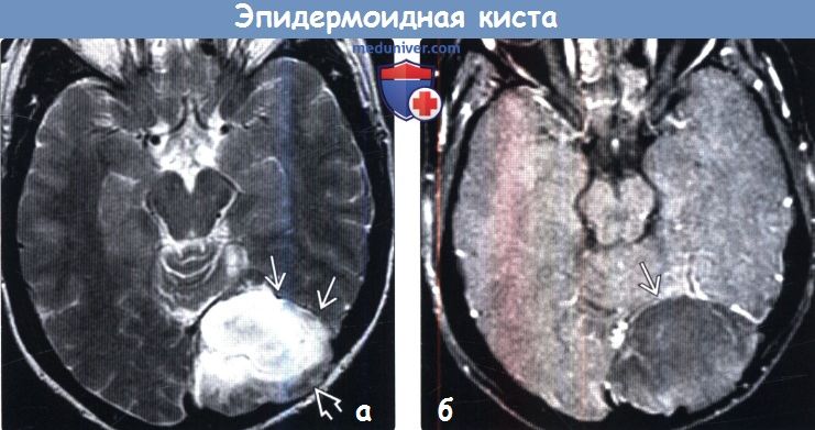 Эпидермоидная киста головного мозга на МРТ