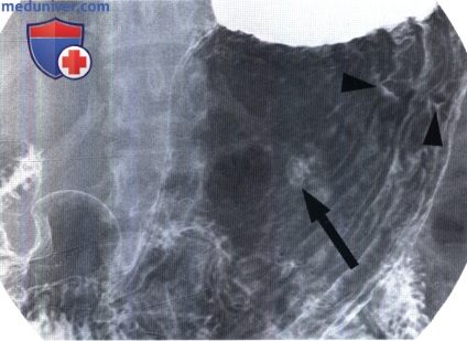 Рентгенограмма при полипе желудка