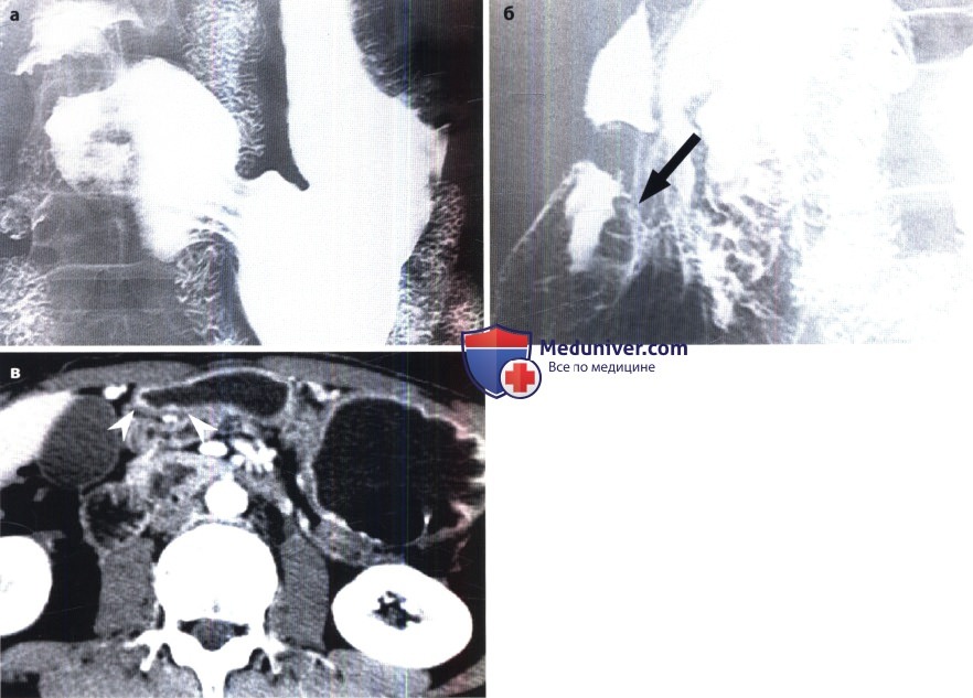 Рентгенограмма, КТ при раке желудка (аденокарциноме желудка)