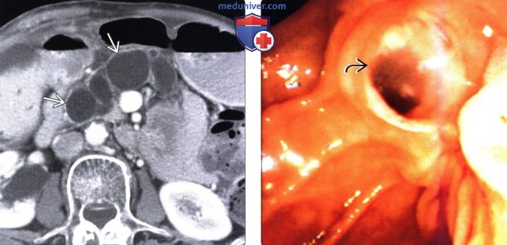 ЭРХПГ, КТ, МРТ, УЗИ при внутрипротоковой папиллярно-муцинозной опухоли (ВПМО) поджелудочной железы