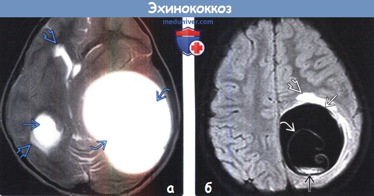 Эхинококкоз головного мозга на МРТ