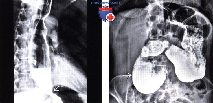 Рентгенограмма (эзофагография) при дискинезии пищевода
